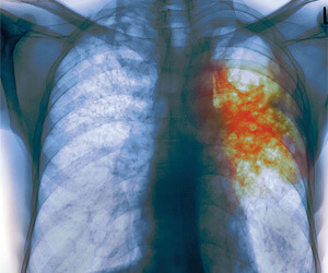 На Тернопільщині майже півсотні людей вперше захворіли на страшну недугу
