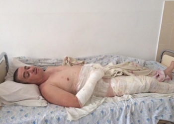 У руках тернополянина вибухнула пляшка з сумішшю для розпалювання