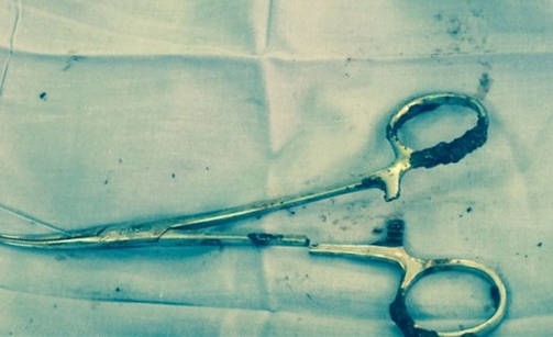 Під час операції медики у животі чоловіка забули ножиці