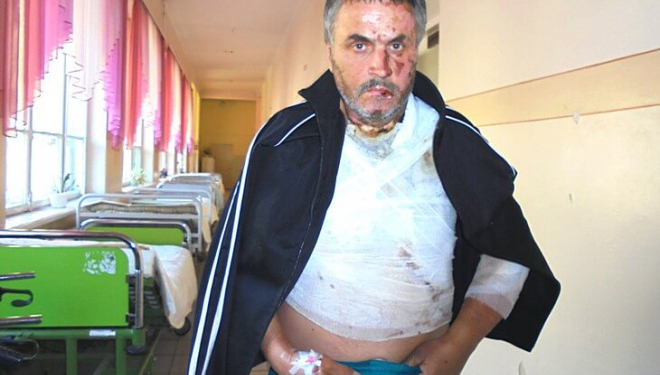 З пекельним болем від опіків тернополянин ледве доїхав у бусі з Польщі