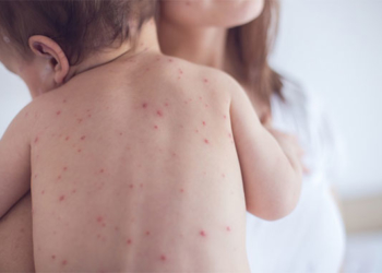 Біля двадцяти тернополян захворіли на кір