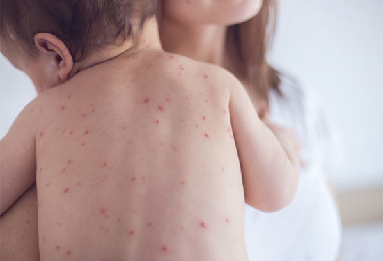 Біля двадцяти тернополян захворіли на кір