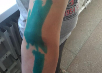 У Тернополі хлопця покусав пітбуль