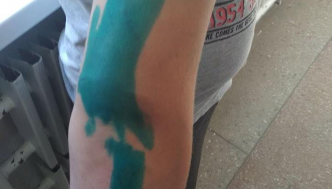 У Тернополі хлопця покусав пітбуль