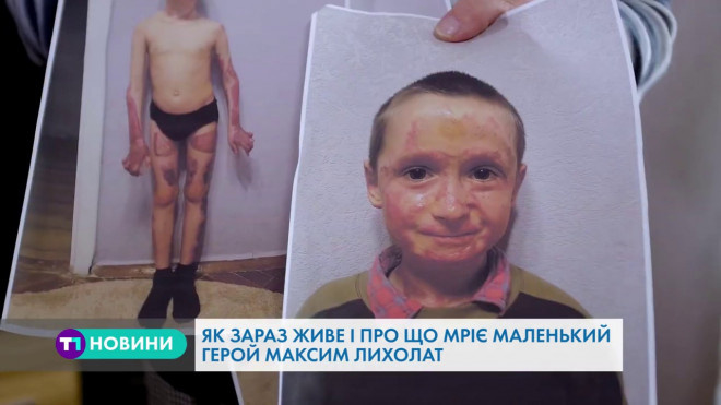 Історія про те, як склалася доля маленького тернополянина, який постраждав від вибуху (Відео)