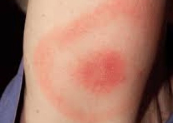 “Самостійно видалили і викинули кліща”: на Тернопільщині зареєстрували два випадки хвороби Лайма