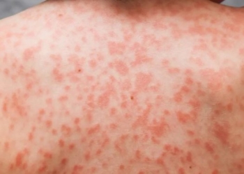 “Зараз на Тернопільщині немає хворих на синдром Кавасакі, викликати який може й Covid-19”, – лікар-інфекціоніст