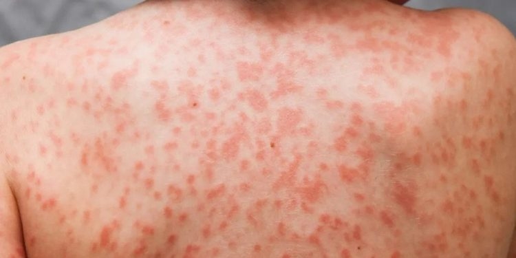 “Зараз на Тернопільщині немає хворих на синдром Кавасакі, викликати який може й Covid-19”, – лікар-інфекціоніст