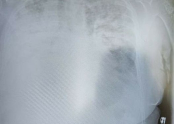 Коронавірус 2:0 : на Тернопільщину повертається “агресивний вірус”