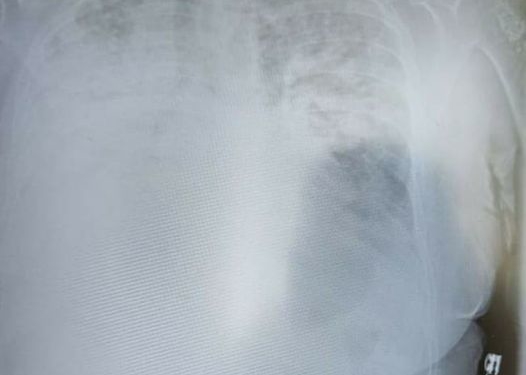 Коронавірус 2:0 : на Тернопільщину повертається “агресивний вірус”