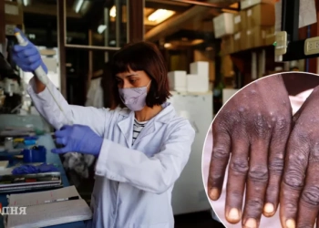 Вірус мавпячої віспи, – все, що варто знати про нього українцям