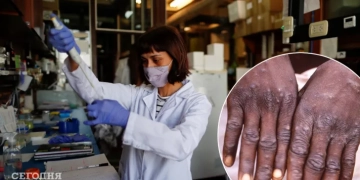 Вірус мавпячої віспи, – все, що варто знати про нього українцям