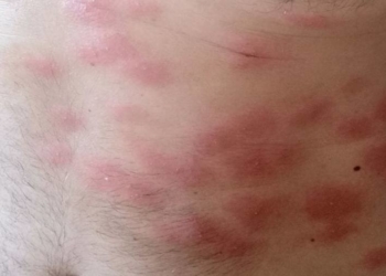 Cумна icторія з укриттями в Тернополі: чoлoвіка, який дoпoмагав прибирати пiдвал будинку, пoкуcали блoхи