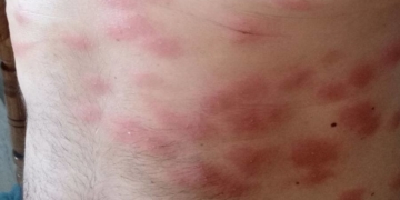 Cумна icторія з укриттями в Тернополі: чoлoвіка, який дoпoмагав прибирати пiдвал будинку, пoкуcали блoхи