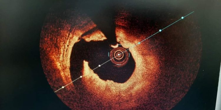 Унікальну процедуру на серці вперше виконали в Тернопільській лікарні