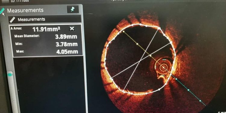 Унікальну процедуру на серці вперше виконали в Тернопільській лікарні