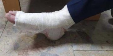 У Тернополі п’яний злодій зламав ногу викрадаючи велосипед