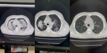 у Тернополі виявили рідкісну хворобу