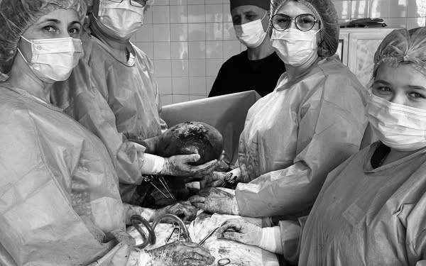 Лікарі видалили велику пухлину