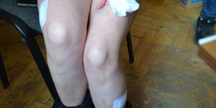 Напад собак на людей