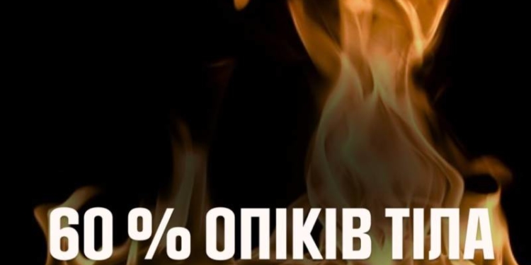 обгоріла жінка