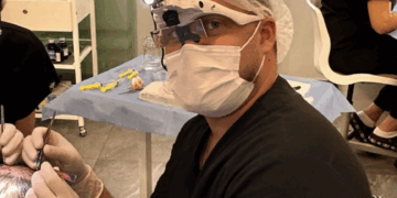 Дивак трансплантація волосся