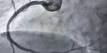 Тернопільські хірурги навчилися чистити артерії